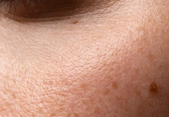 Cilt Gözenekleri Nedir? Gözenek Sıkılaştırma Nasıl Yapılır?