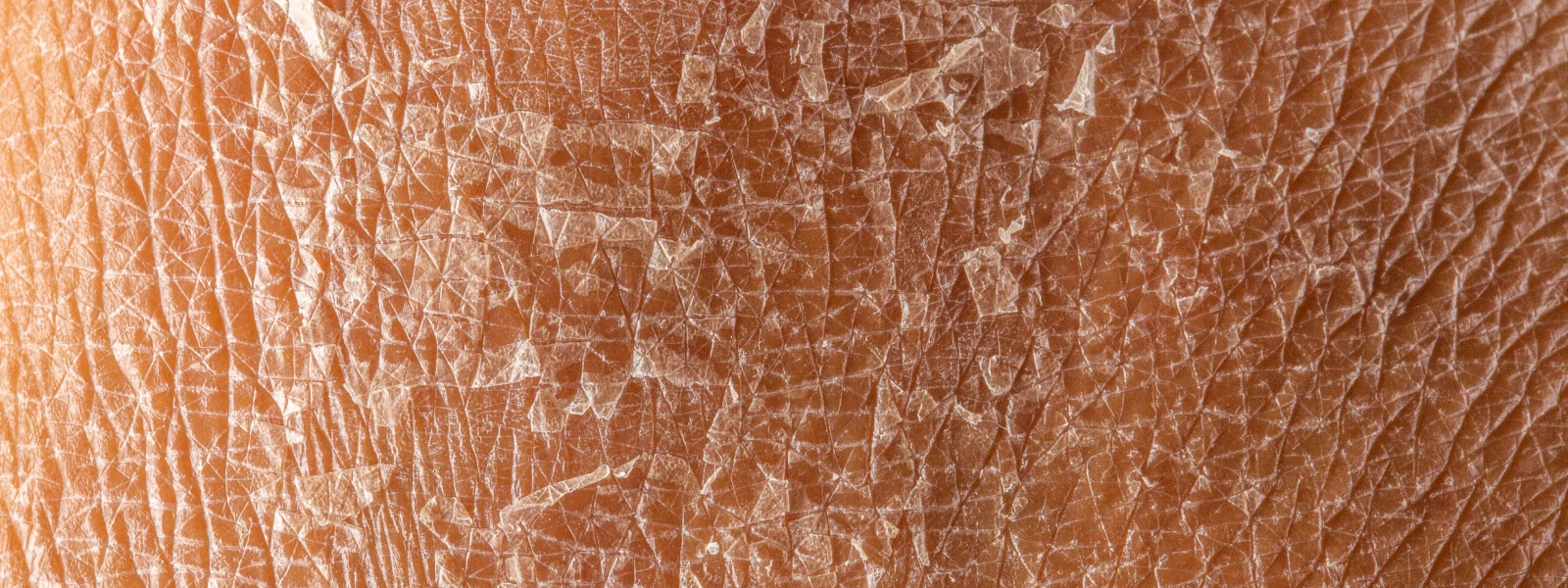 Cilt Kuruluğu Neden Olur? Cilt Kuruluğuna Ne İyi Gelir?