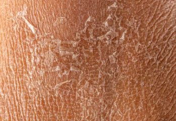 Cilt Kuruluğu Neden Olur? Cilt Kuruluguna Ne İyi Gelir?