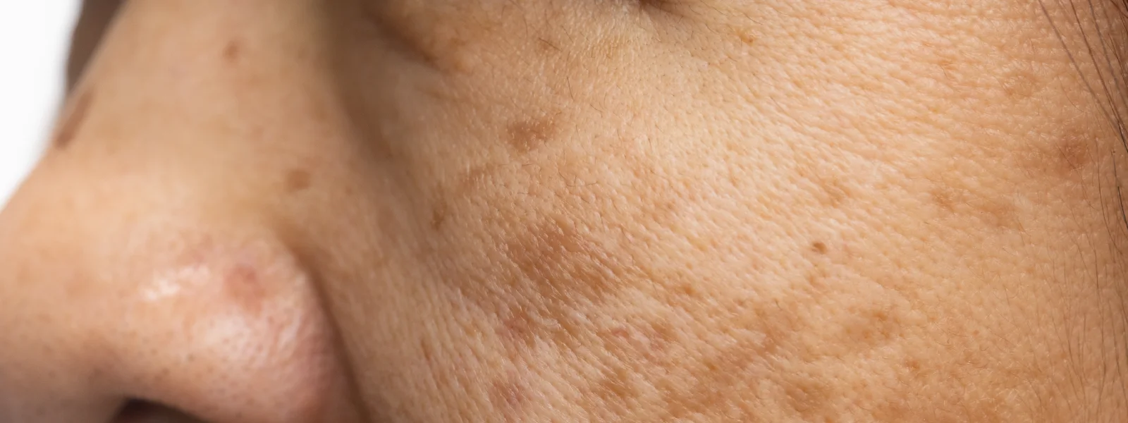 Kimyasal Peeling