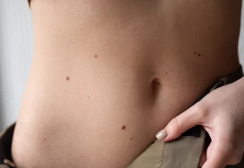 Ciltte Kahverengi Lekeler Neden Olur? Nasıl Geçer? Vücutta Kahverengi Lekeler Nasıl Geçer?