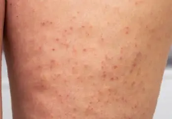 Ciltte Tavuk Derisi Hastalığı Nedir? Keratosis Pilaris Nasıl Geçer?