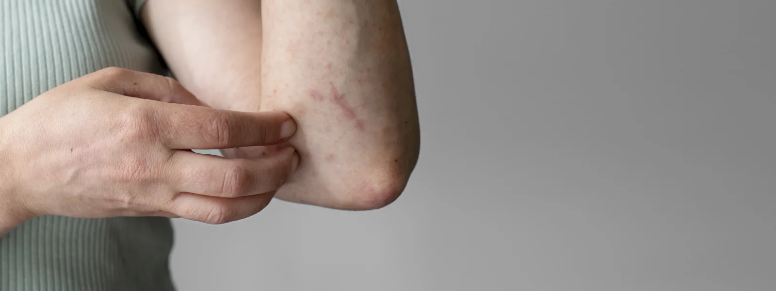 Keratosis Pilaris Sorunu Daha Çok Kimlerde Görülür?