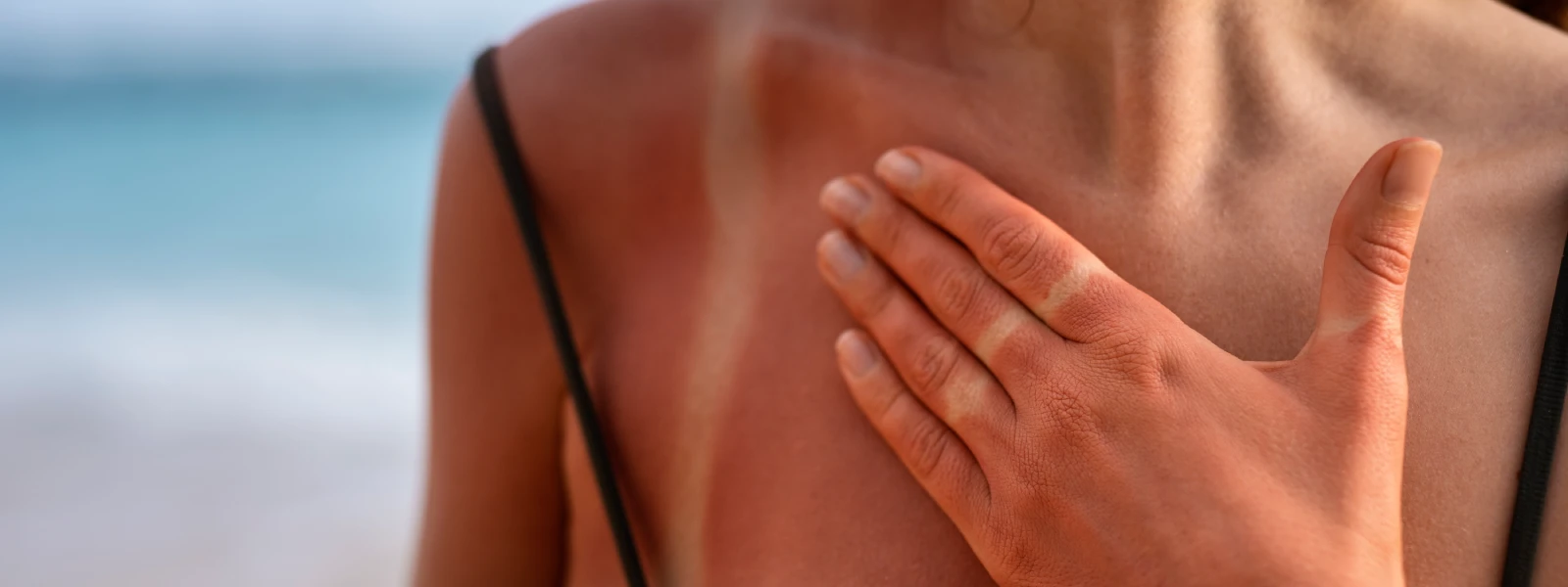 Güneş Alerjisi Belirtileri