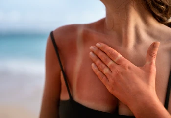 Güneş Alerjisi Nedir? Güneş Alerjisi Beliritleri Nelerdir?