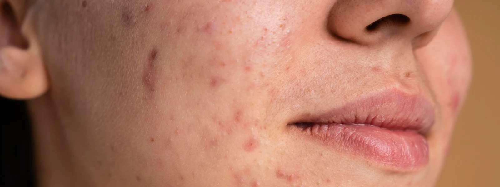 Yıpranmış Cilt Nasıl Düzelir? Bakımı Nasıl Olmalıdır?