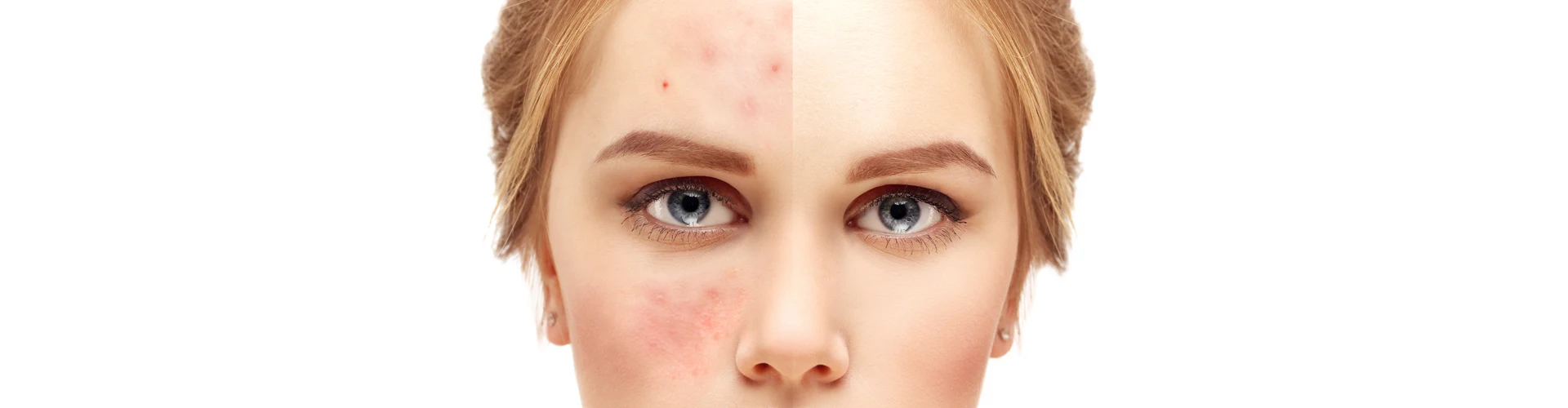 Yıpranmış Cilt Nasıl Düzelir?