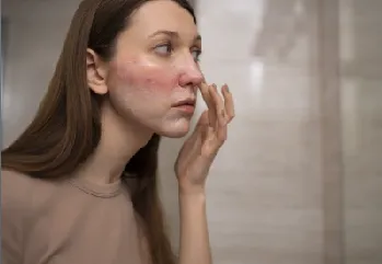 Yüzde Kızarıklık Neden Olur? Yüzdeki Kızarıklık Nasıl Geçer?