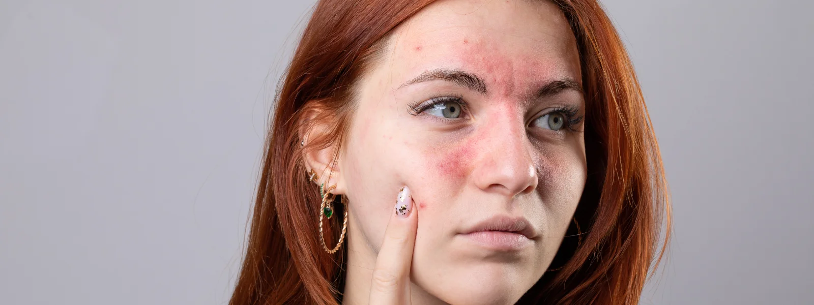 İltihaplı Sivilce Neden Oluşur? İltihaplı Sivilceler Nasıl Geçer?