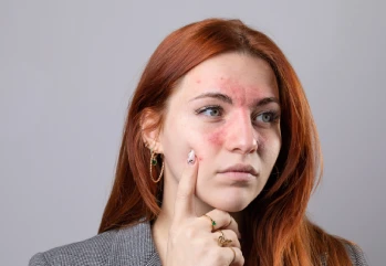 İltihaplı Sivilce Neden Oluşur? Nasıl Geçer?