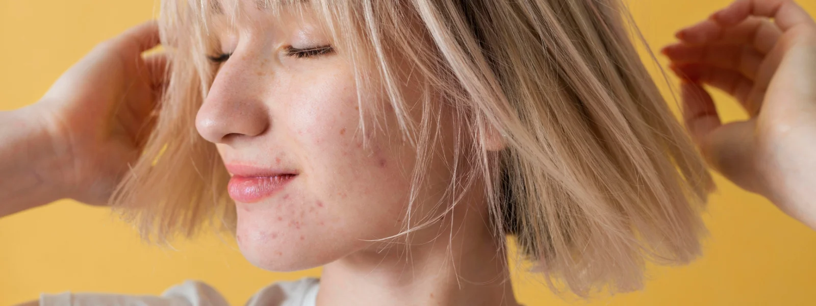 Kör Sivilce Nasıl Geçer?