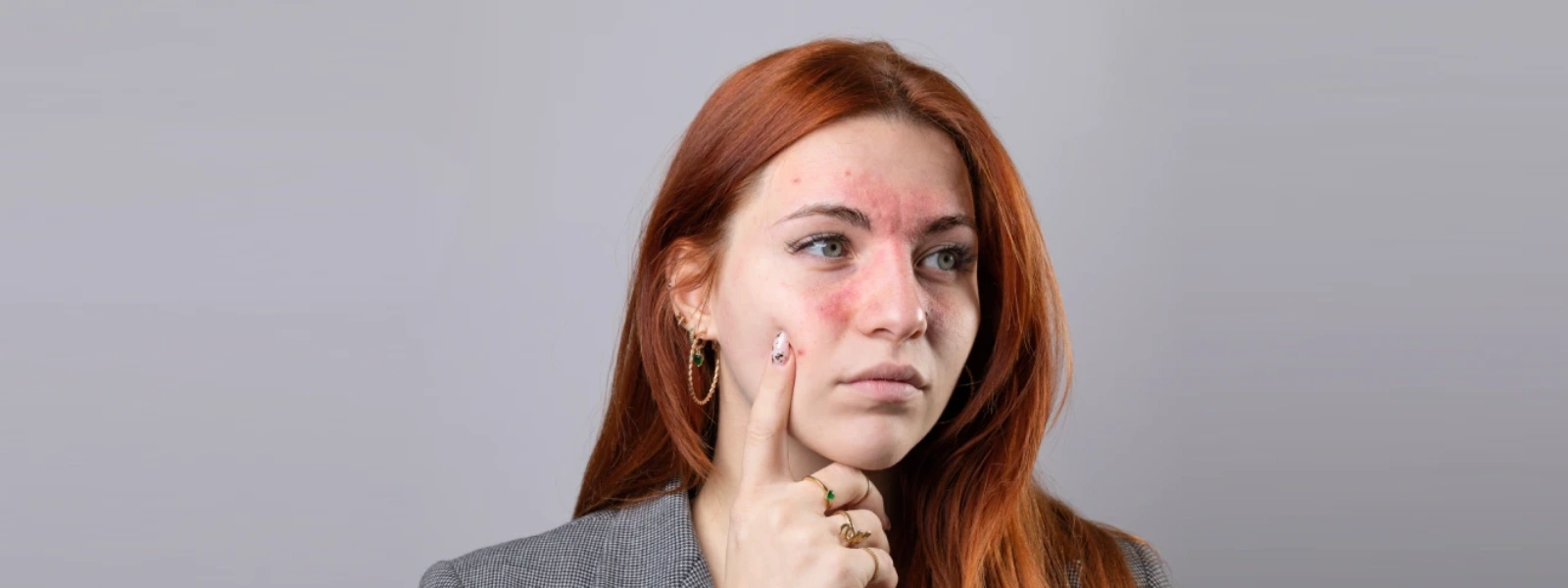 Kör Sivilce Nasıl Geçer?