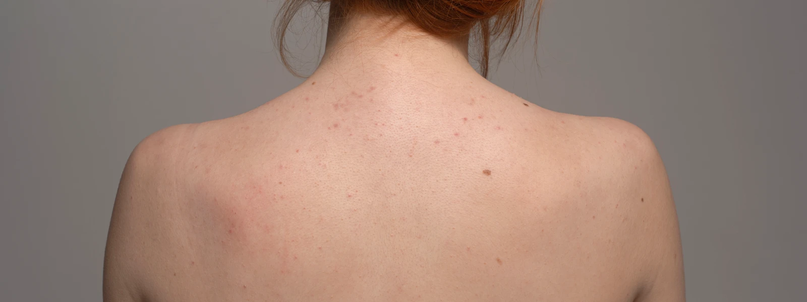 Vücut Sivilcesi Neden Çıkar? Vücut Sivilcesi Nasıl Geçer?