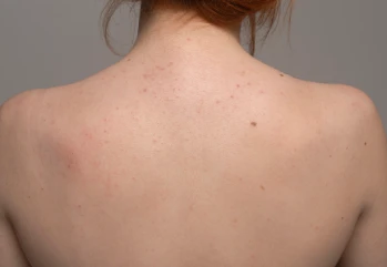 Vücut Sivilcesi Neden Çıkar? Vücut Sivilceleri Nasıl Geçer?