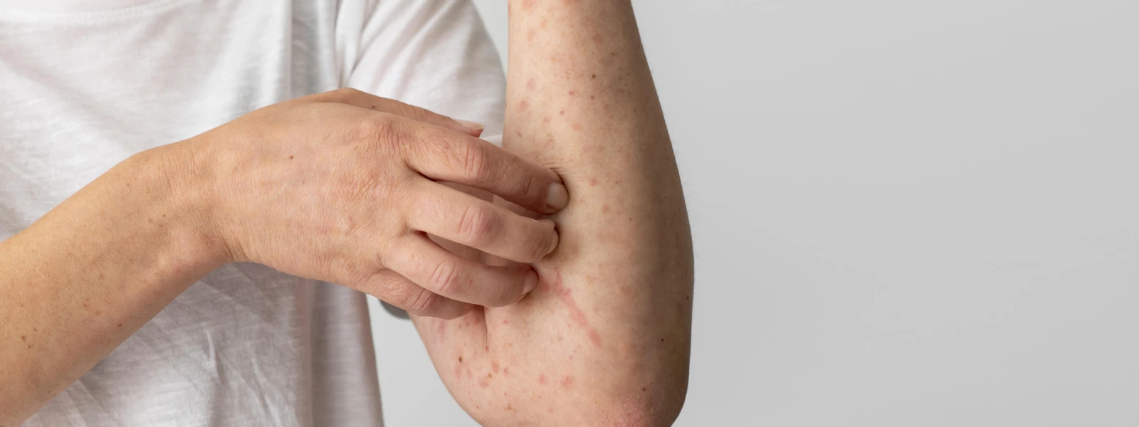 histamin alerjisi nedir