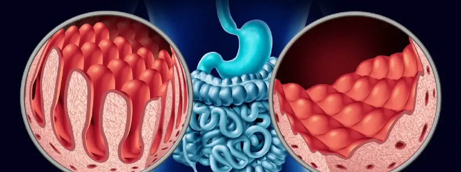 Çölyak Hastalığı Nedir? Çölyak Hastalığının Belirtileri Nelerdir?