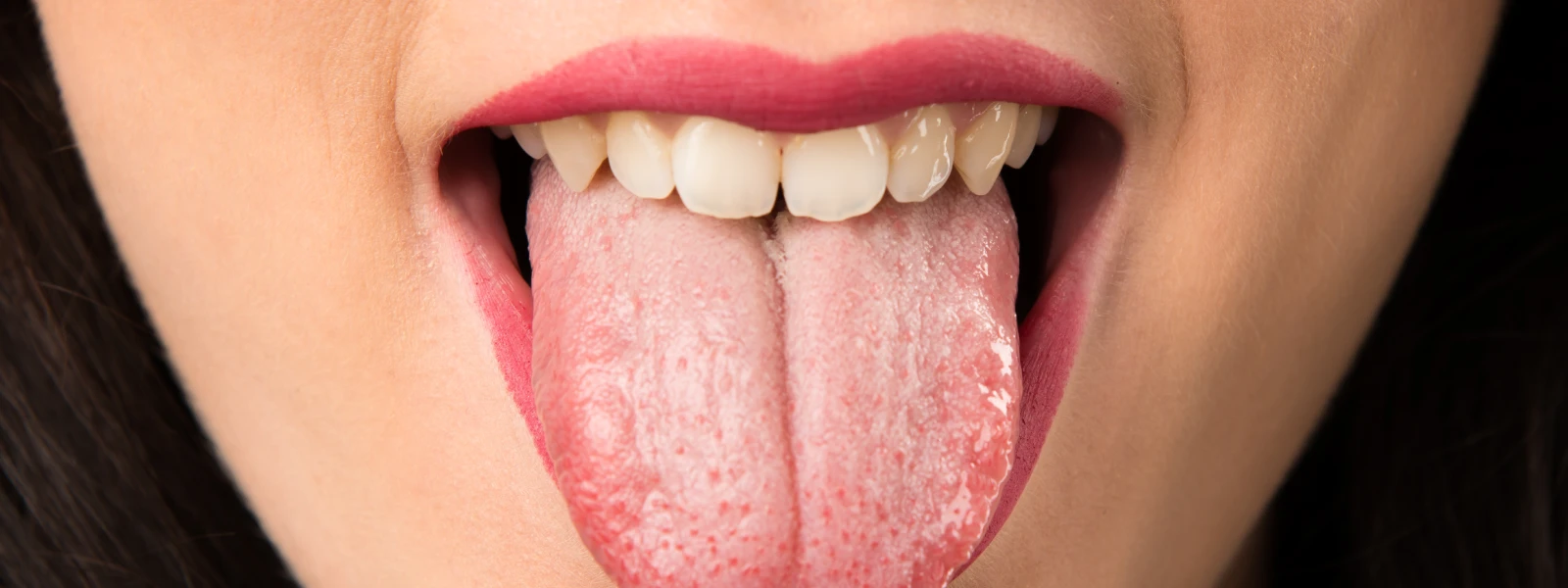 Dilde Beyazlık Hangi Vitamin Eksikliğinden Kaynaklanır? 