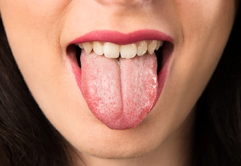Dilde Beyazlık Hangi Vitamin Eksikliğinden Olur